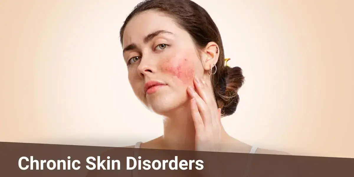 chronic skin disorders, homeopathy treatment for skin, best homeopathic medicine for skin disease, homeopathic skin medicine, homeopathic remedy for skin allergy, treatment for skin problems, homeopathic remedy for pimples, chronic autoimmune skin disease, homeopathic medicine for skin allergy, the homeopathy world